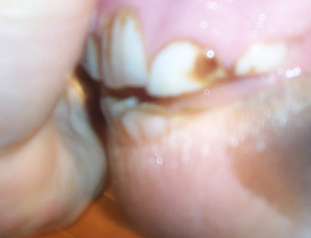 tooth in question