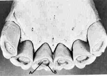8yr old bottom incisors